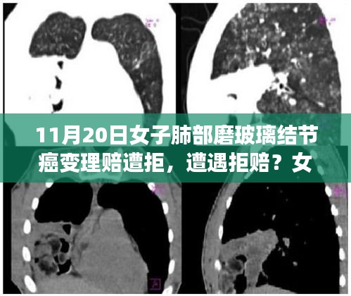 女子肺部磨玻璃結(jié)節(jié)癌變遭拒賠，理賠攻略詳解揭秘真相